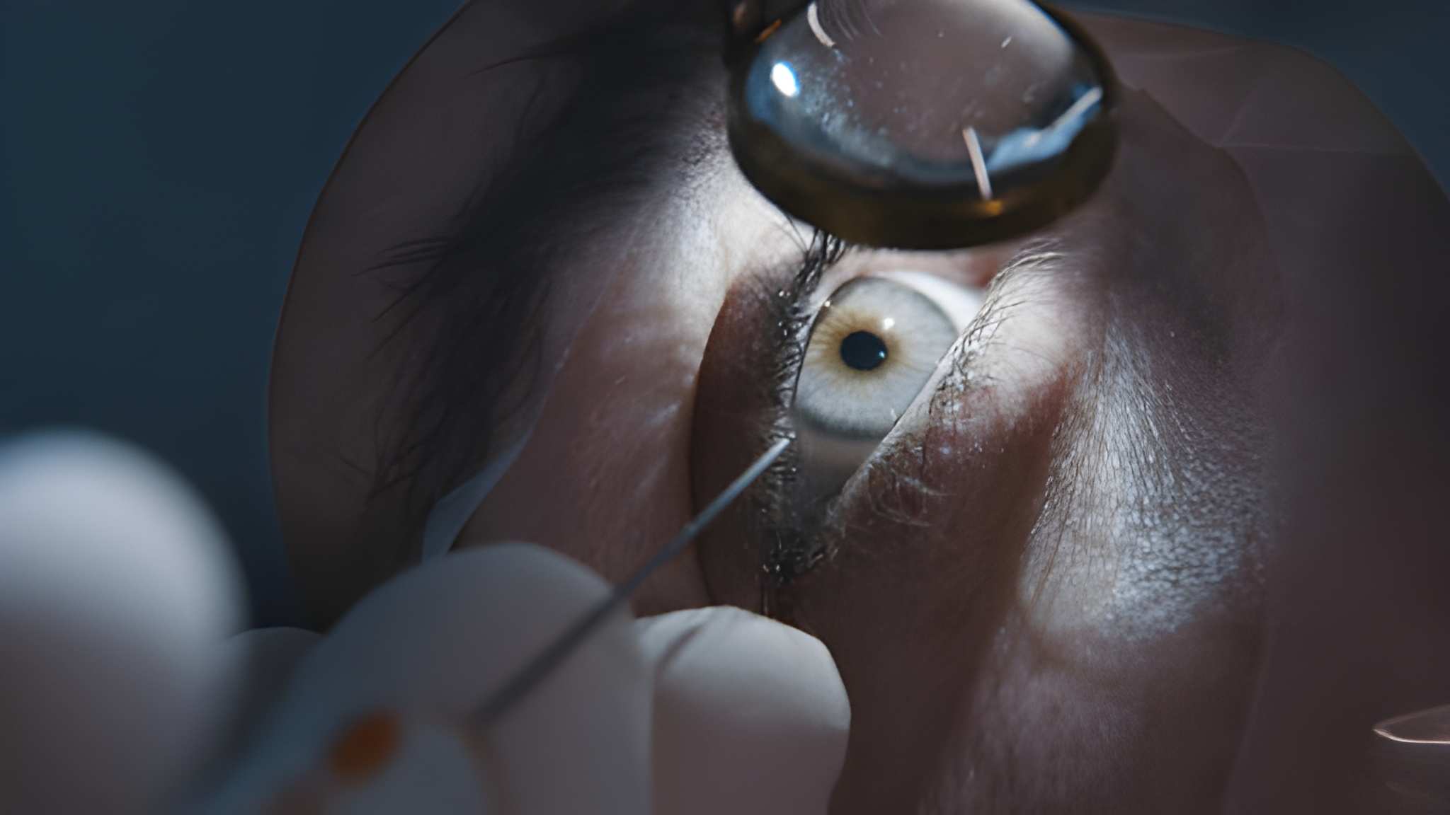 Refrakcyjna wymiana soczewek "smartlenses"